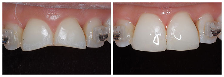 dental bonding before and after