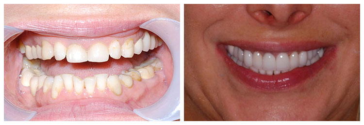 veneers and implants before and after