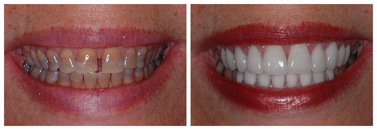 teeth whitening before and after