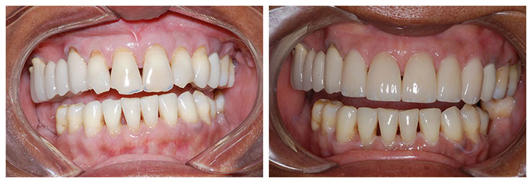 veneers before and after